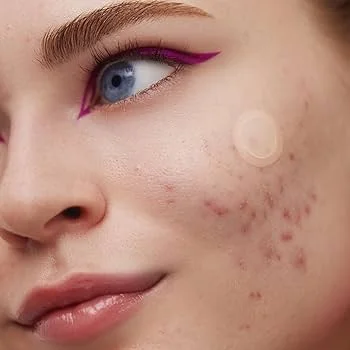 Acne Spot